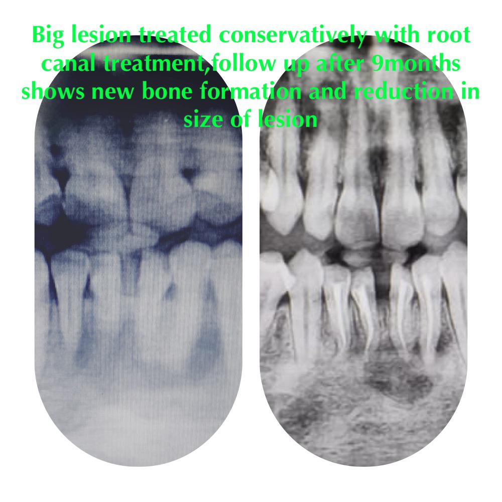 Conservative Lesion Treatment