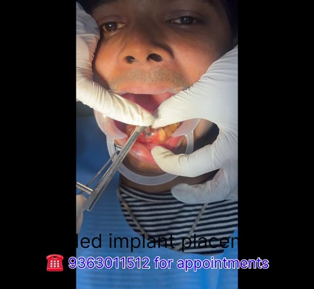 Guided Implant Placement