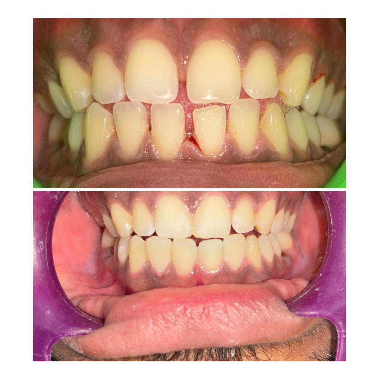 Tooth Reshaping & Restoration