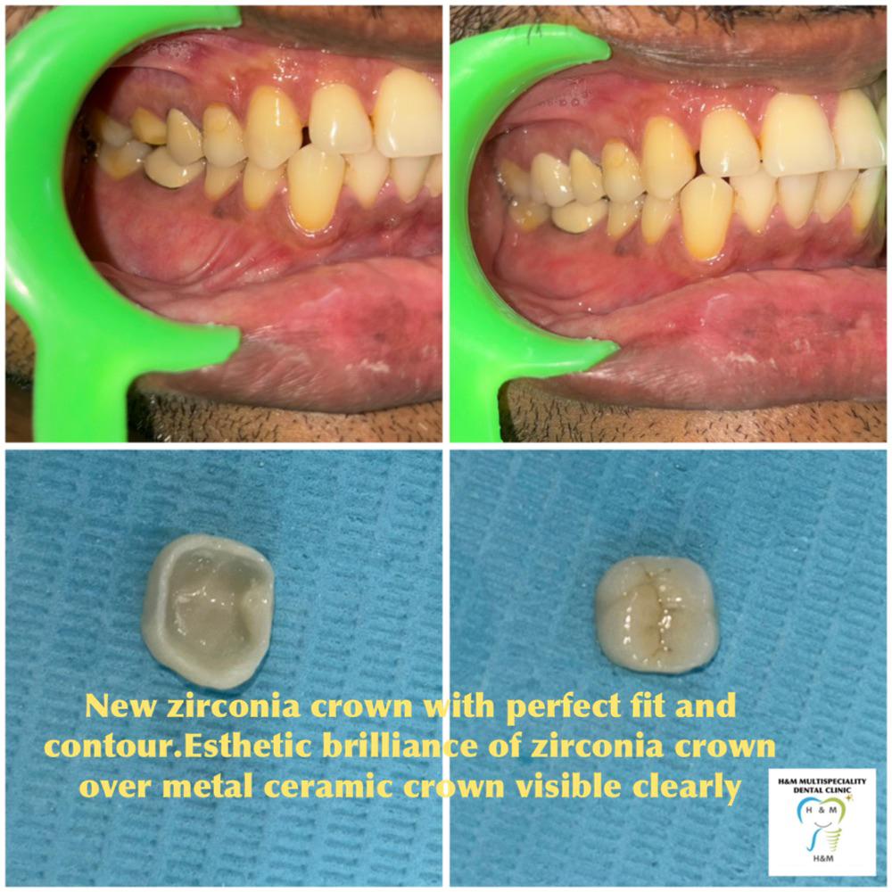 Zirconia crown before and after